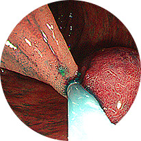 大腸内視鏡検査 ( 大腸カメラ )･ポリープ切除